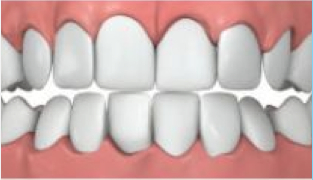 Engstand_Invisalign Engstand_Invisalign.jpg