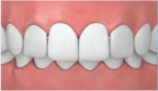 Überbiss_Invisalign Überbiss_Invisalign.jpg