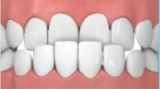Progenie_Invisalign Progenie_Invisalign.jpg