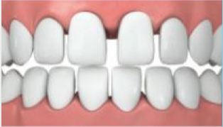 Lückenstand_Invisalign Lückenstand_Invisalign.jpg