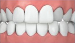 Kreuzbiss-Invisalign Kreuzbiss-Invisalign.jpg