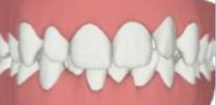 Tiefbiss-Invisalign Tiefbiss-Invisalign.jpg1